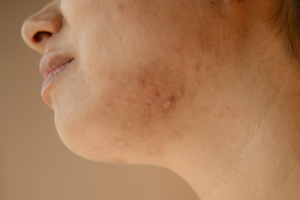 Stevens-Johnson Syndrome